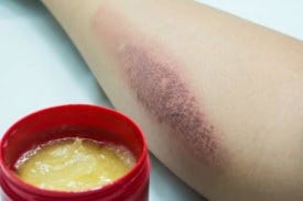Burn treatment cream and arm with burn